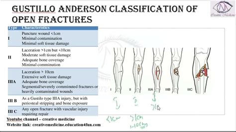 Lec 7 Gustillo Anderson Classification Of Open Fractures Mp4