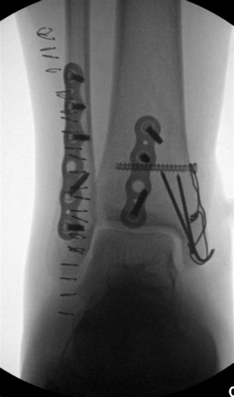 Is Tension Band Fixation Underutilized For Medial Malleolar Fractures