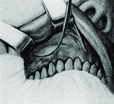 Semilunar Incision On The Buccal Mucosa As Promulgated By Partsch In