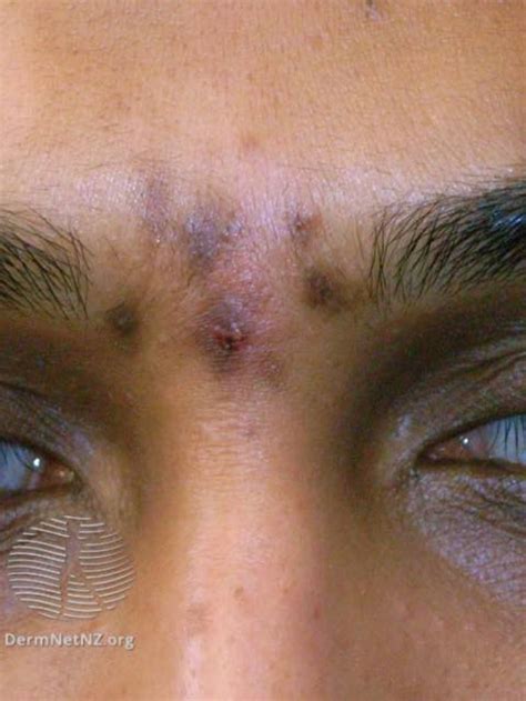 Post Inflammatory Hyperpigmentation And Acne