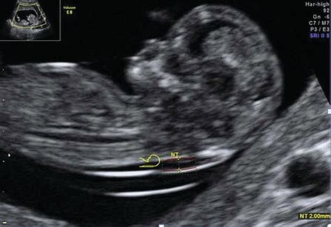 Down Syndrome 20 Week Ultrasound