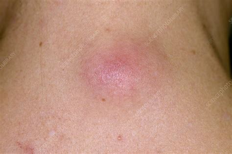 Infected Sebaceous Cyst Stock Image C0263281 Science Photo Library