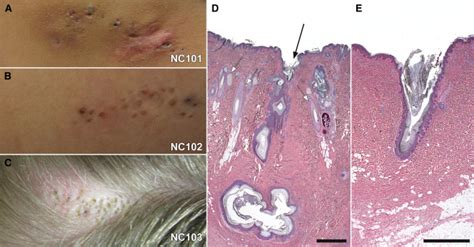 Somatic Mutations In Nek9 Cause Nevus Comedonicus The American Journal