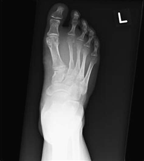 Synovial Sarcoma Arising In The Foot Case Report The Journal Of Foot