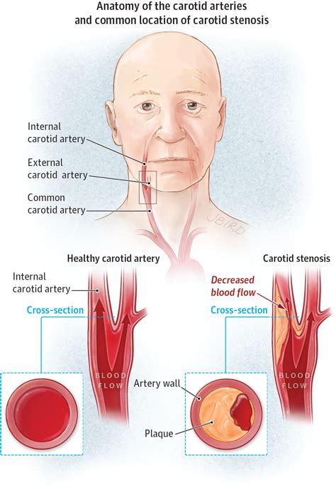 Testing For Carotid Stenosis Cerebrovascular Disease Jama Jama