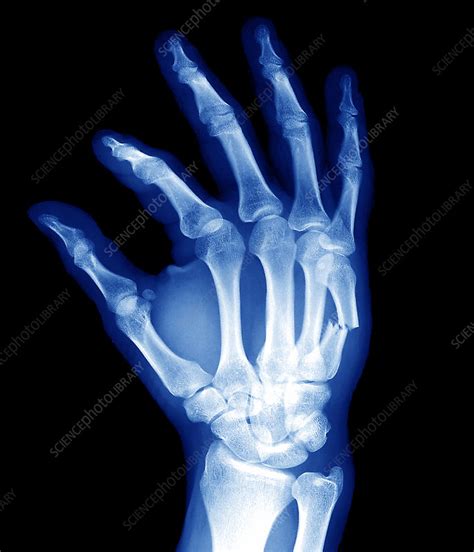 Broken Hand Bone X Ray Stock Image M3300968