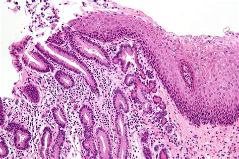 Pancreatic Acinar Metaplasia Stratified Squamous Epithelium