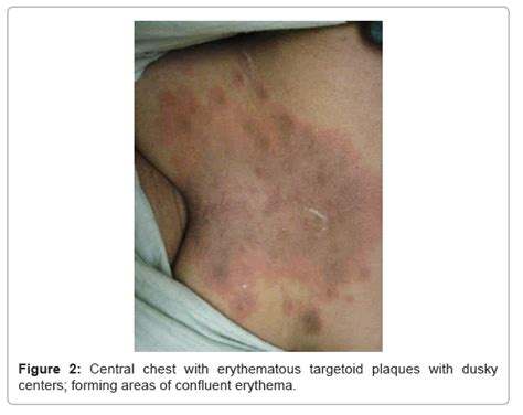 Clinical Experimental Dermatology Targetoid Plaques