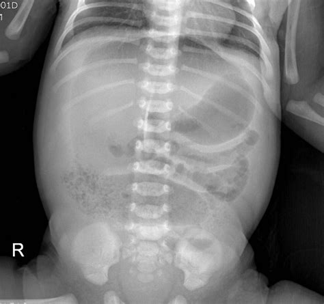 Plain Radiograph In A Neonate With Abdominal Distension The Bmj