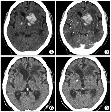 Initial Brain Computed Tomography Ct Demonstrates An Intracerebral