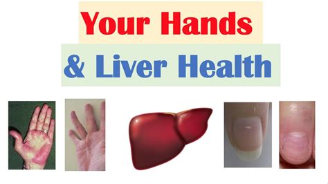Liver Disease Signs And Symptoms Archives Uohere