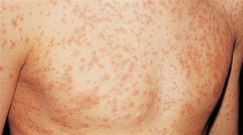 Identifying Skin Rashes Pictures Photos