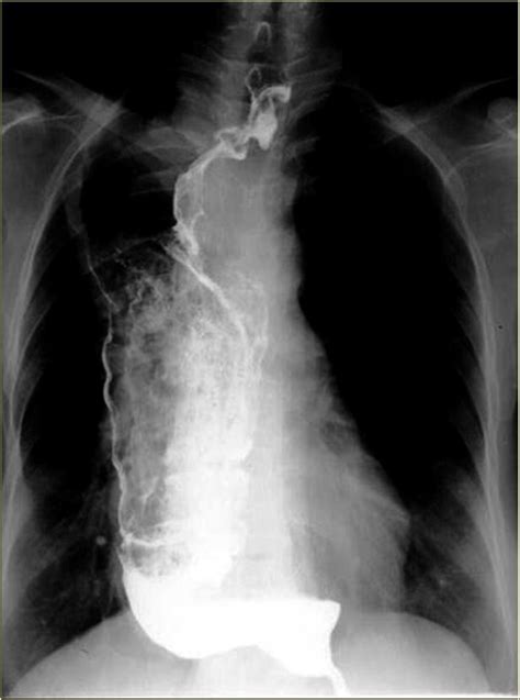 Esophageal Cancer In Achalasia Radrounds Radiology Network