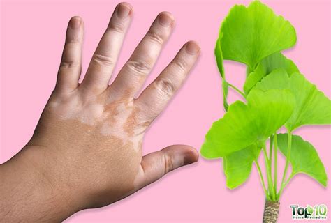 How To Get Rid Of White Patches On Skin Vitiligo Top 10 Home Remedies