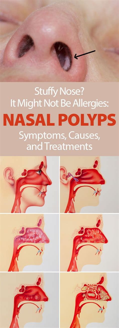 Nasal Polyps Causes Symptoms Natural Treatment Nasal