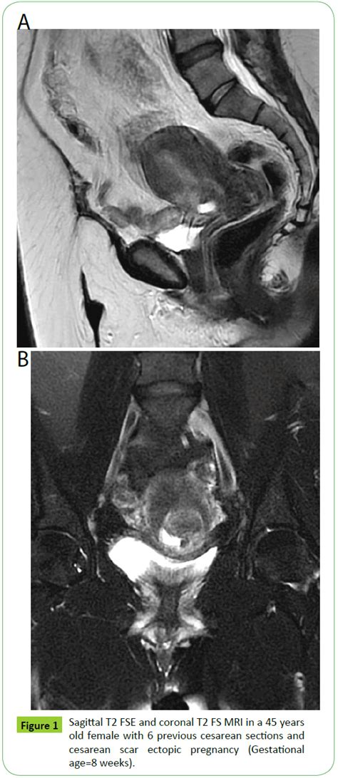 Mri In Cesarean Scar Ectopic Pregnancy Insight Medical Publishing