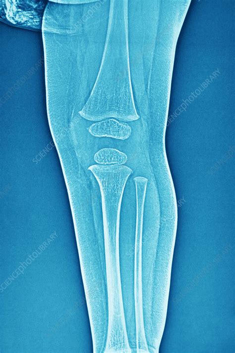 Normal Babys Knee X Ray Stock Image C0269075 Science Photo Library