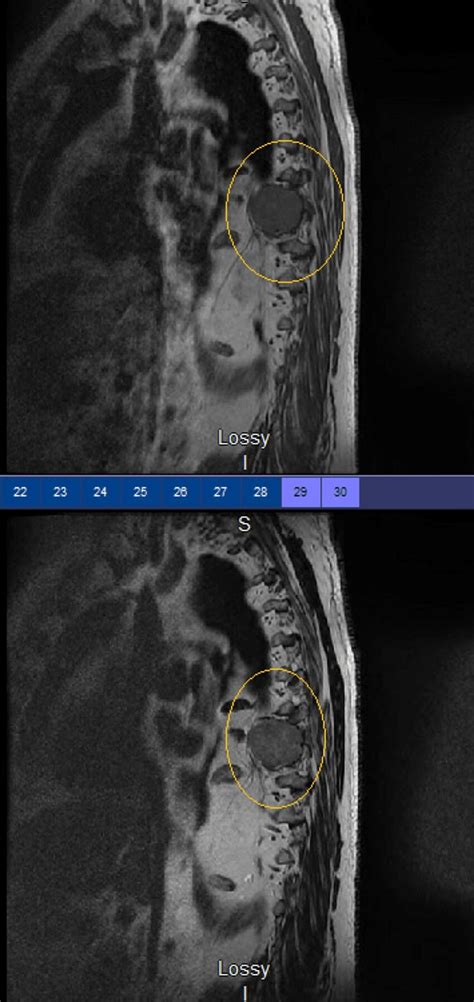 MRI Of The Thoracic Spine With And Without Contrast Revealing A Download Scientific Diagram