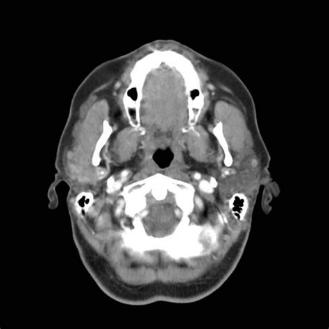 Cect Shows An Ill Defined Mass Located In The Superficial Lobe Of The