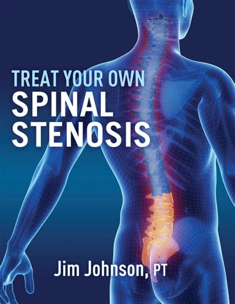 Treat Your Own Spinal Stenosis Paperback