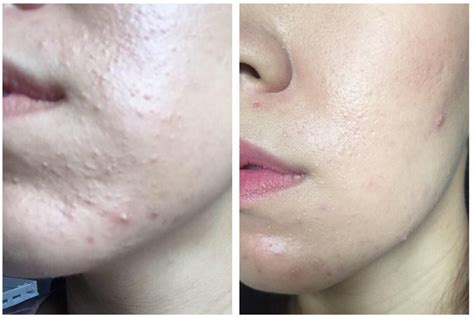 To eliminate fungal acne fast, there is a need to unclog the skin pores and fight both the yeast and fungal acne/folliculitis can last for many weeks, months, or even years if not treated correctly. ACNE B&A Fungal Acne Skin Update!! 7 weeks difference!