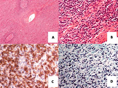 Diagnostic Cues For Natural Killer Cell Lymphoma Primary Nodal