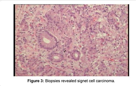 Figure 3 From Virchow Node And Gastric Cancer Clinical Diagnosis Is
