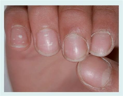 Do You Have White Spot On Nails Causes And Treatment Of Leukonychia