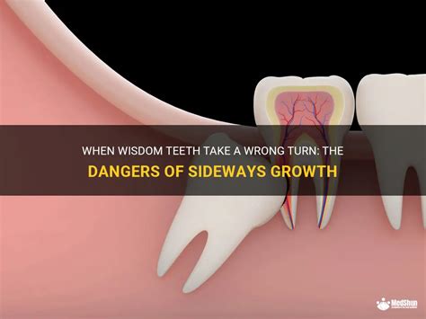 When Wisdom Teeth Take A Wrong Turn The Dangers Of Sideways Growth