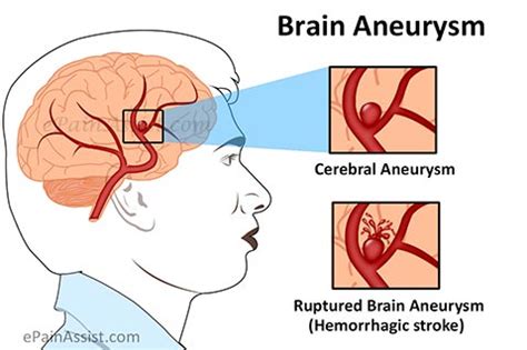 Aneurysm was recorded on november 9, 1991, on bbc radio 1 with mark goodier. What Can Cause Brain Aneurysm or Cerebral Aneurysm and How ...