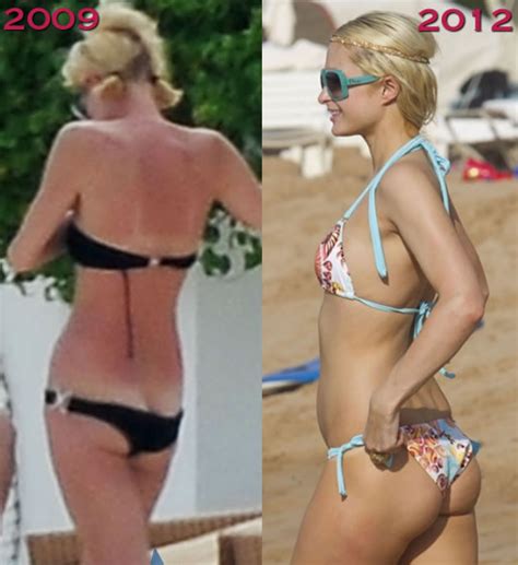 Paris Hilton Before And After Surgery Telegraph