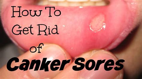 How To Get Rid Of Canker Sores Canker Sore Canker Sore Remedy Cankers