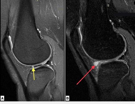 Mri Pre Op And Post Op A T2 Sagittal Image Of The Right Knee Of A Download Scientific Diagram