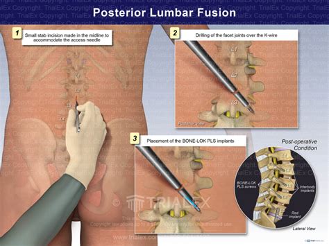 Posterior Lumbar Fusion Trialexhibits Inc