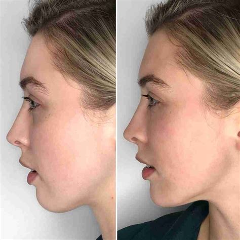Chin Filler Archives Dr Aaron Stanes Anti Ageing And Cosmetic