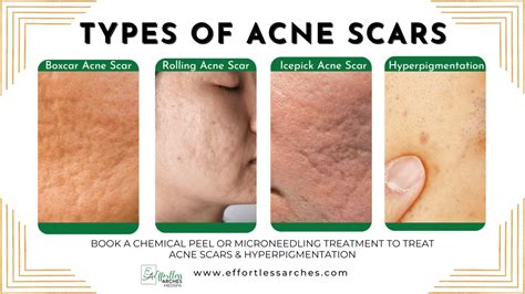 Acne Scars Vs Hyperpigmentation Whats The Difference