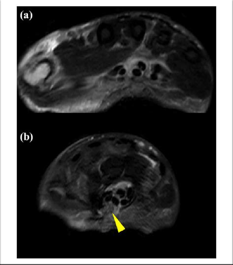 Mri Scans Of The Left Hand After The Carpal Tunnel Release Revealed