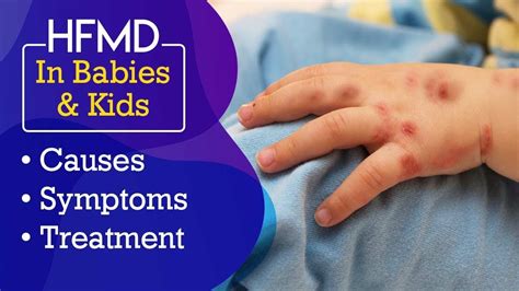 Hand Foot And Mouth Disease Hfmd In Babies Youtube
