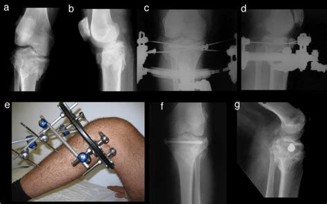 Definitive Treatment Of Tibial Plateau Fracture With Hybrid External