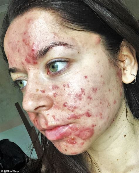 Real Skin With Spots And Acne