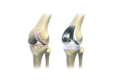 All About Knee Prosthesis For Whom When And Scenarios Moving