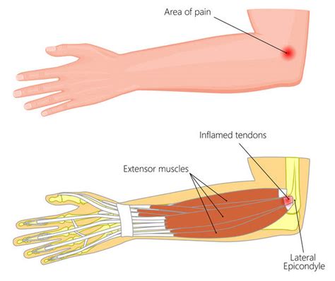 Tennis Elbow Treatment And Prevention Lateral Epicondylitis