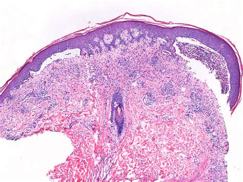 Cureus A Case Of Drug Induced Bullous Pemphigoid With An Isomorphic