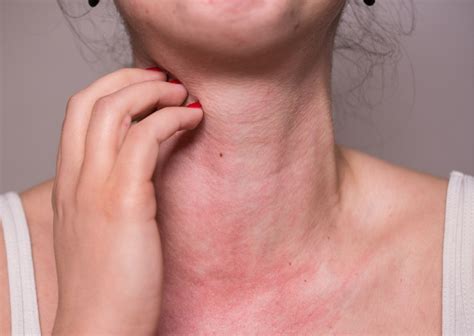 Réactions Allergiques Et Anaphylaxie Définition Cause Symptômes
