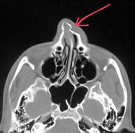 Nasal Bone Fracture Mri Nasal Bone Fracture Radiology Case