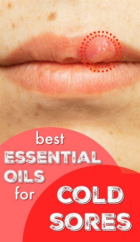 Best Essential Oils For Cold Sores Natural Remedies Cold Sore