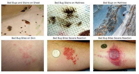 Bed Bug Symptoms Pictures When They Appear And Treatment