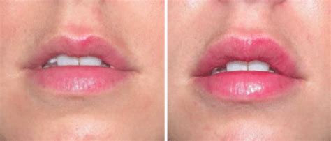 Restylane Lyft Lips Before And After