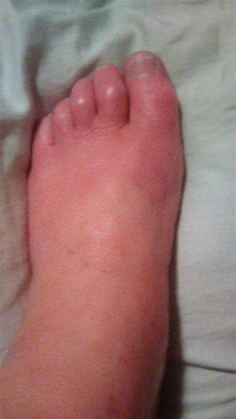 Left Foot Swollen Red And Extremely Hot In 2020 Foot Pics Feet Red