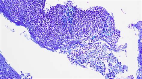 Same Sample Of Fig 2 In Giemsa 20× Magnification Diffuse